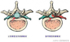 腰椎管狭窄症如何预防？