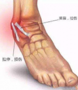 踝关节扭伤怎么办？